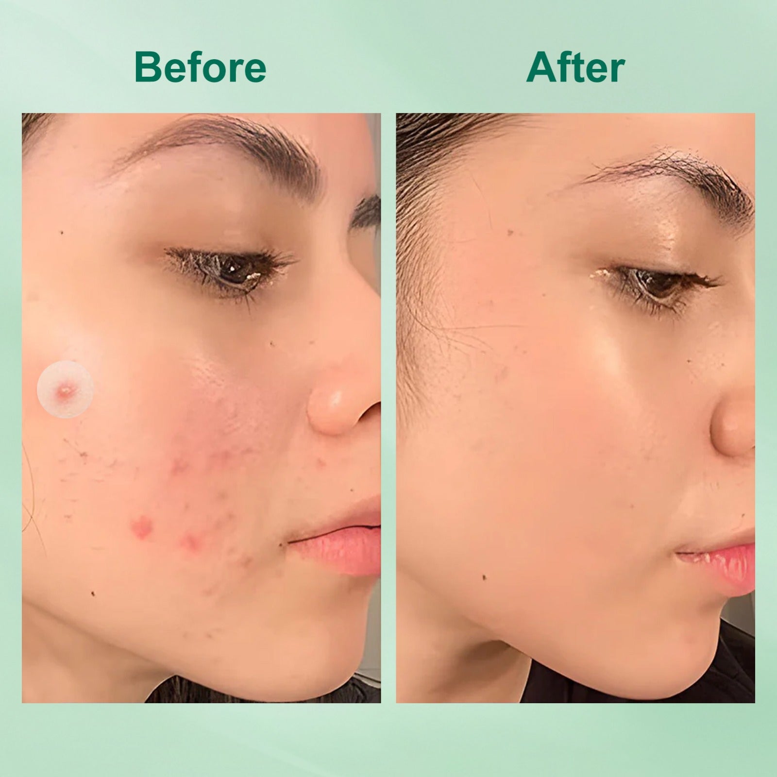 Acne Pimple Patches – Hydrocolloid Spot Dots