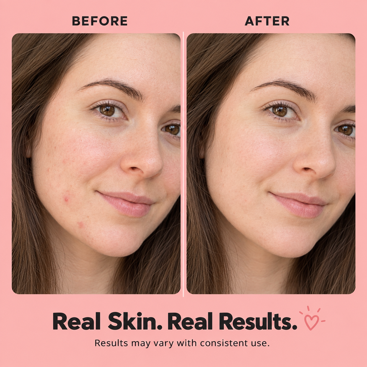 Acne Patches – 96 Hydrocolloid Spot Dots